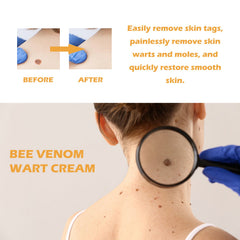 Ximonth Bee Venom Wart Cream